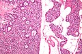 Parathyroid adenoma intermed mag.jpg