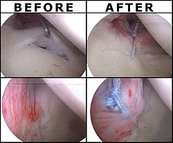 Arthroscopic SLAP Lesion (type 2) repair SLAP-Lesion-before-after-EN.jpg