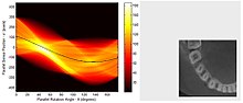 Left image is a sinogram which is a graphic representation of the raw data obtained from a CT scan. At right is an image sample derived from the raw data. Sinogram and sample image of computed tomography of the jaw.jpg