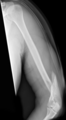 A spiral fracture of the distal one-third of the humerus shaft