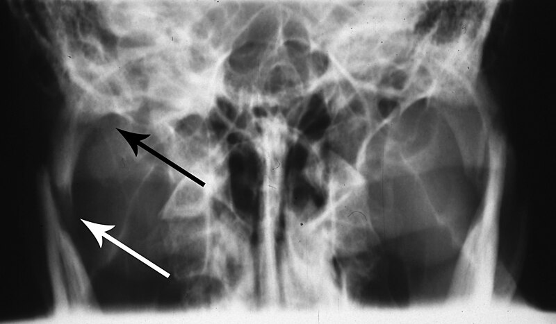 File:Townes view bilateral condyle fracture.jpg