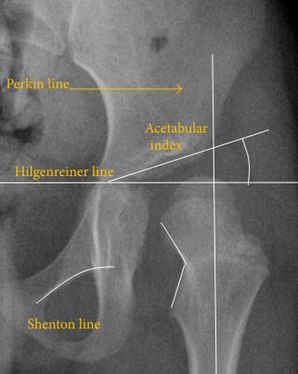 Figure 2B. Hip dysplasia.[1]