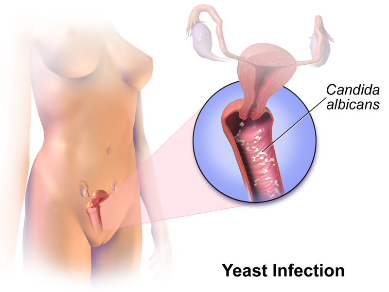 File:Yeast Infection.png