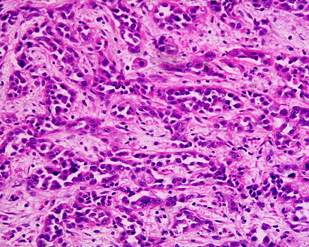 Tập_tin:Adenocarcinoma_low_differentiated_(stomach)_H&E_magn_400x.jpg