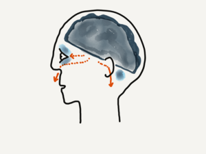 Basilar Skull Fracture