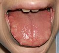 Neurofibromas del borde de la lengua de un paciente de 23 años con síndrome MEN tipo IIb