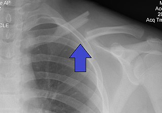 Clavicle fracture Medical condition