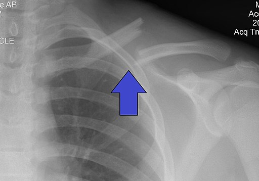 File:Shoulder dislocation with Bankart and Hill-Sachs lesion, before and  after reduction.jpg - Wikipedia