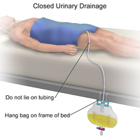 Closed Urinary Drainage Illustration