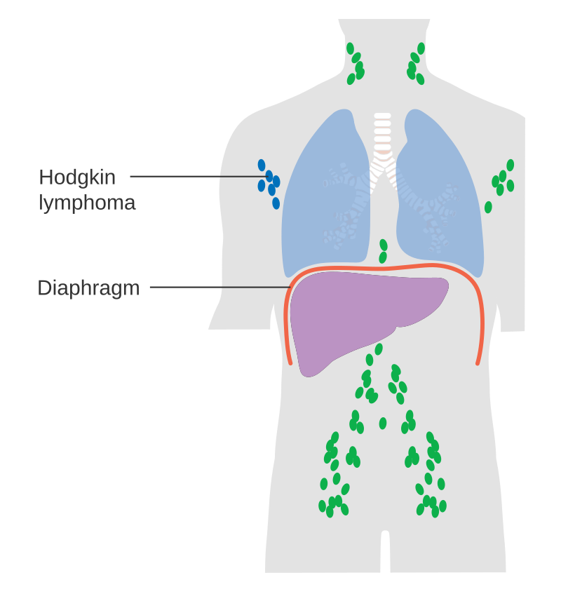 Diagram showing stage 1 Hogkin's lymphoma CRUK 191.svg