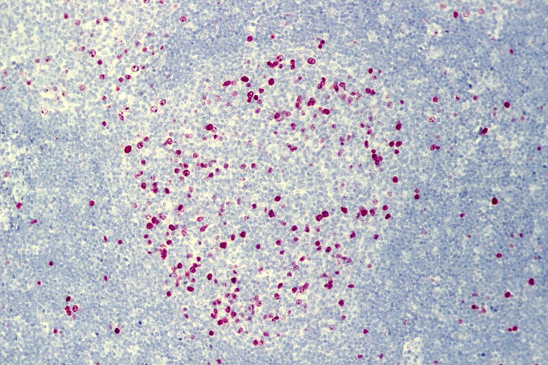 File:Follicular lymphoma, Mib1.jpg