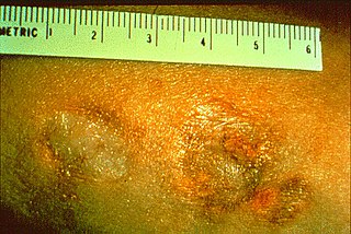 <span class="mw-page-title-main">Beryllium granuloma</span> Medical condition