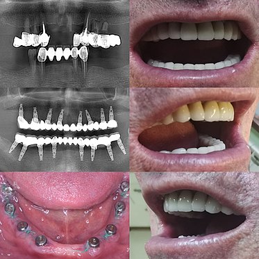 implant dentar toata gura