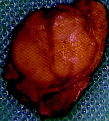 Gross appearance of insulinoma showing the typical red-brown appearance of tumour Insulinoma.jpg