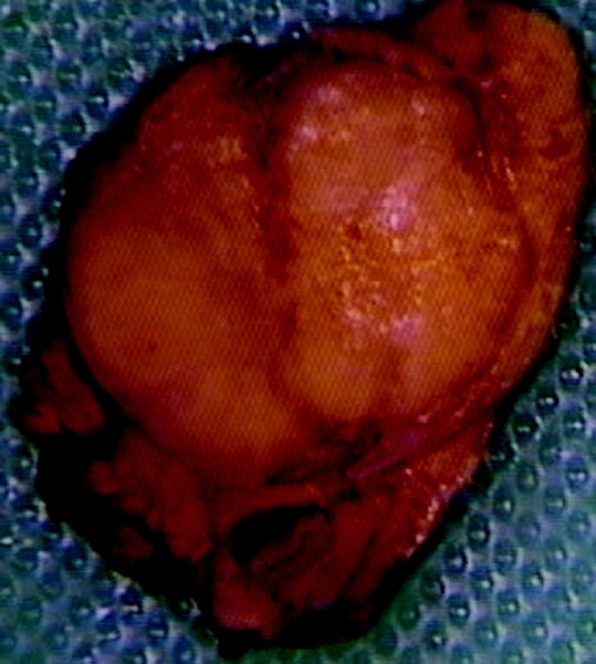 File:Insulinoma.jpg