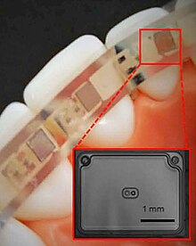 Flexible Li batteries have been embedded into dental braces for powering light-emitting diodes in light-assisted therapy Intra-oral flexible battery 2.jpg