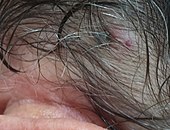 Ixodes holocyclus Adult female tick - four to five day attachment on human skin behind ear. Lymph node on neck is swollen and a very large area around the tick is inflicted with hypoesthesia (numbness) Ixodholfem9a.jpg