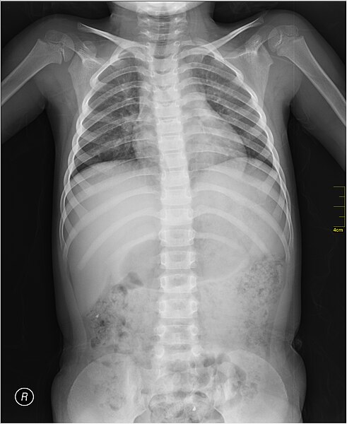 File:Medical X-Ray imaging WHR07 nevit.jpg