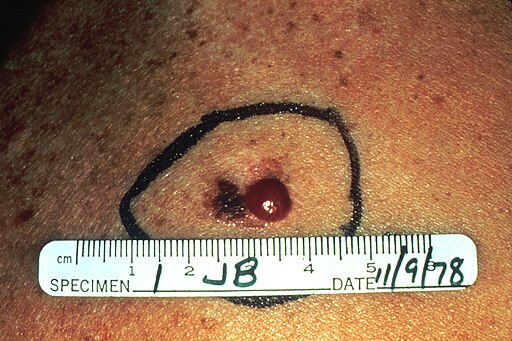 Melanoma3