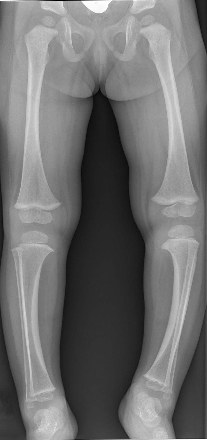 File:Enchondrom Tibia 83jm - Roe ap und seitlich - 001.jpg - Wikimedia  Commons