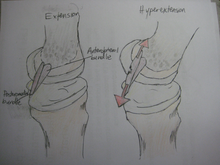 In this medial view of the extended knee, the lateral femoral condyle has been removed to reveal the structure of the PCL. Because the posteromedial bundle is stretched and the anterolateral bundle relaxed during extension, excessive extension in the form of hyperextension causes tensile stress, shown in red, on the posteromedial bundle of the PCL that leads to PCL injury. PCL Extension and Hyperextension.png