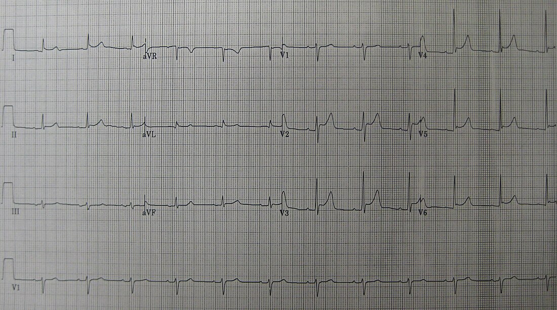 Acute pericarditis