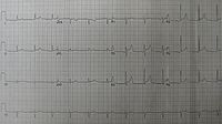 Pericarditis