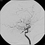 Miniatura para Arteria trigeminal