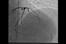 Datei: Primäre Angioplastie-für-Herz-Allotransplantat-Vaskulopathie-Präsentieren-als-ST-Elevation-Acute-Myocardial-606481.f1.ogv