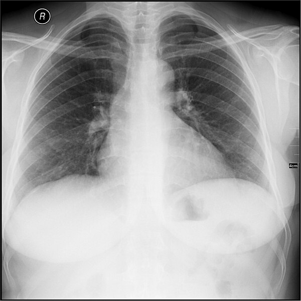 File:Radiology ND 0125 ADH.jpg