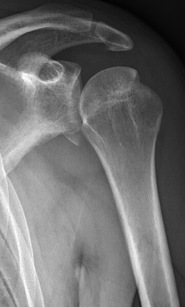 File:Shoulder dislocation, anteroposterior after reduction, with Bankart and Hill-Sachs lesions, without labels.jpg