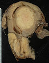 बड़े स्क्वैमस कार्सिनोमा (चित्र के नीचे) ने योनिद्वार को घेरकर निचले गर्भाशय तक पहुंच गया है।