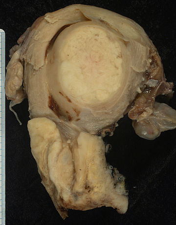 File:Squamous carcinoma of the cervix.jpg