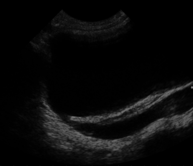 Ultrasound showing vesicoureteral reflux