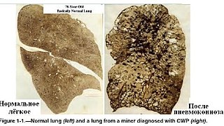 Die Pneumokoniose oder Staublu