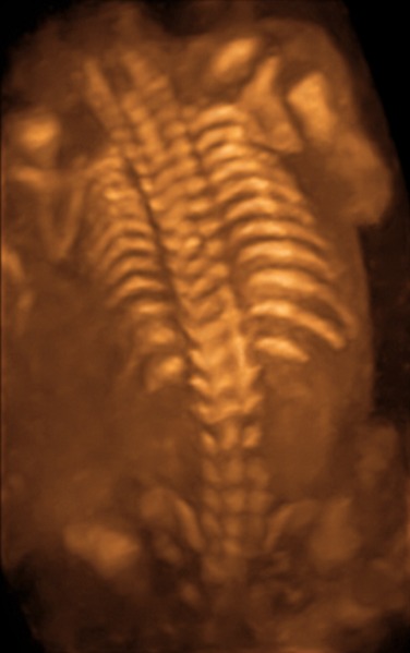 File:3D sonogram of fetal spine.tif