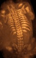 Three-dimensional ultrasound image of the fetal spine at 21 weeks of pregnancy