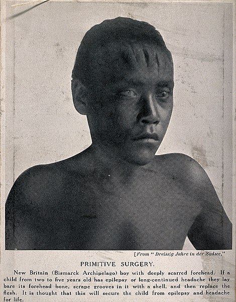 File:A boy with deep scars on his forehead as a result of surgery Wellcome V0015970.jpg