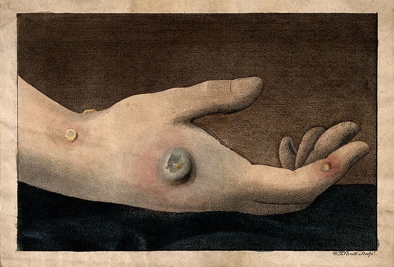 File:A human hand with smallpox pustules. Coloured etching by W.T Wellcome V0016680.jpg