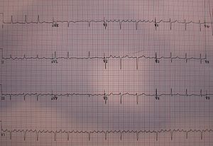 Type I atrial flutter, counterclockwise rotation with 3:1 and 4:1 AV nodal block. AtrialFlutter12.JPG