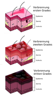 Vorschaubild für Verbrennung (Medizin)