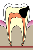 Hammasmätä on edennyt hammasytimen (punaisella merkitty alue) tulehdukseksi saakka.