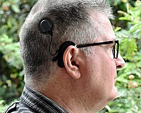 Cochlear Implant