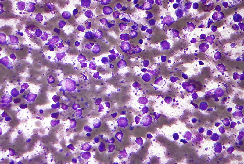 קובץ:Diffuse large B cell lymphoma - cytology low mag.jpg