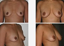 Example of breast augmentation by fat grafting Dr. Placik Chicago Breast Fat Grafting 19097.jpg