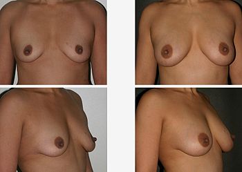 Non-implant breast augmentation: the pre-procedural aspects (left) and the post-procedural aspects (right) of breasts enlarged and contoured with autologous fat grafts Dr. Placik Chicago Breast Fat Grafting 19097.jpg