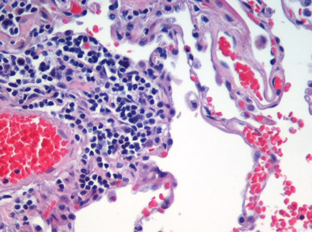 Microscopic view of a histologic specimen of human lung, consisting of various tissues: blood, connective tissue, vascular endothelium and respiratory