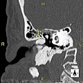 Exostosis in ear canal