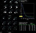 Thumbnail for Gastric emptying study