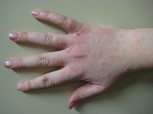 Human hand with dermatitis.jpg